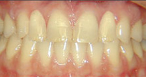 The image shows a close-up view of a person s teeth with a focus on a yellowed front tooth, which appears to be discolored or stained.