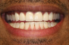 The image shows a close-up of a person s smiling mouth with white teeth, displaying a wide smile with a visible gap between the two front teeth.