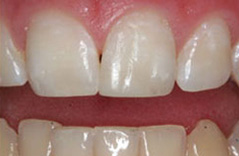 The image shows a close-up of a person s teeth with a focus on their lower front teeth, which appear to be veneered or enhanced in color and shape.