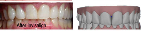 The image shows before-and-after dental implant results, with one side showing teeth with gaps and discoloration, and the other side displaying a fully restored set of white teeth.