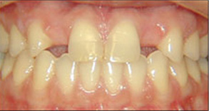 The image shows a close-up view of a person s teeth with visible signs of wear and discoloration, taken from a lower angle looking up at the mouth.