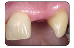 The image shows a close-up view of a person s mouth with teeth visible, where some teeth appear to be missing or damaged, and there are signs of dental work or issues such as gum inflammation or decayed teeth.