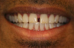 The image features a close-up of a person s smiling mouth with visible teeth, including a prominent front tooth.
