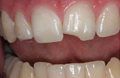 The image shows a close-up view of a person s teeth with a focus on a dental implant and surrounding natural teeth, highlighting the difference between them.