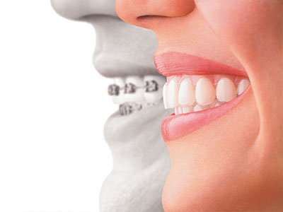 The image features a split-screen comparison of a person s face with and without dental braces, emphasizing the transformative effect of orthodontic treatment on one s smile.