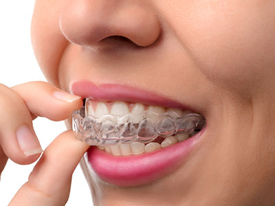 The image shows a person with a clear aligner on their teeth, holding the aligner up against their lips while looking directly at the camera.