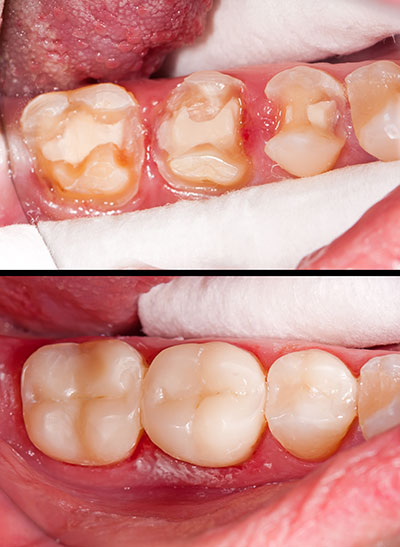 The image shows a close-up view of an open mouth with teeth, including a front tooth with a large cavity, and gums with signs of inflammation and possible infection.