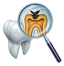 The image shows a magnified view of a tooth with an open crown through which we can see the interior structure of the tooth, including the pulp chamber and root canal system, along with a small, dark spot that could be interpreted as a cavity or decay.