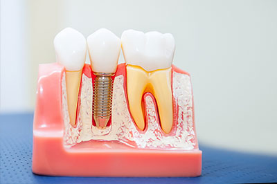 The image features a set of artificial teeth with visible dental implants, displayed on a pink plastic model designed to represent a mouth, against a blue background.