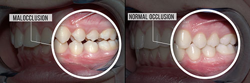 The image shows a side-by-side comparison of a person s teeth before and after dental work, highlighting the transformation from malocclusion to normal occlusion.