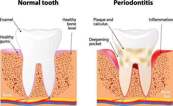 The image shows a detailed illustration of the oral cavity and its structures, with labels indicating normal teeth, bone, gums, and periodontitis, highlighting the differences between healthy and diseased states, including annotations for enamel, calcium deposits, and inflammation.