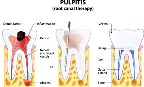 The image shows a diagrammatic representation of the dental pulpitis process, illustrating the stages from inflammation to infection with annotations pointing out the different parts involved in tooth decay.