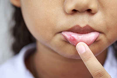 A young child with acne on their face, holding their finger up to their mouth.