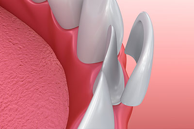 The image shows a close-up view of a dental implant with a pink gum background and a focus on the implant s metallic surface.