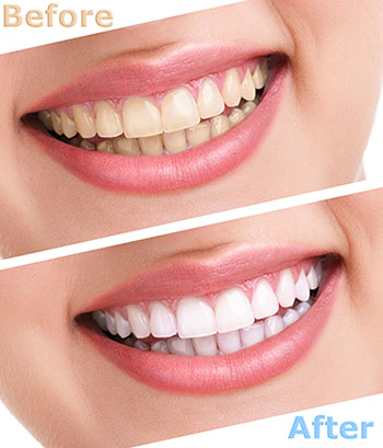 The image shows a comparison of a person s teeth before and after dental treatment, highlighting the improvement in whiteness and straightness.