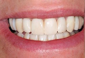 The image displays a close-up view of an individual s teeth, which are white and appear to be well-maintained.