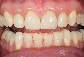 The image shows a close-up view of a person s teeth with visible staining, particularly on the front teeth, which are prominently displayed against a dark background.