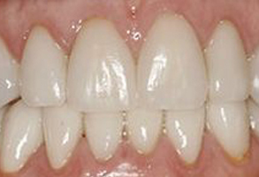 The image shows a close-up view of a person's teeth with an emphasis on a large gap between two front teeth, which appears to be due to missing teeth or dental issues requiring attention.