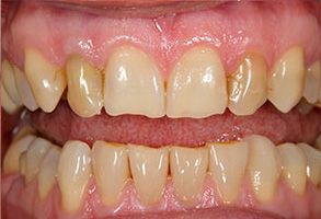 The image displays a close-up of an individual s teeth with yellowing and staining visible on some surfaces, suggesting a need for dental care or whitening treatment.