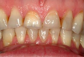 The image shows a close-up of a person's teeth with visible signs of dental decay, discoloration, and potential gum disease.